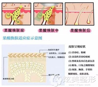 彭静主任讲果酸焕肤的治疗原理及适应症 彭静主任讲果酸焕肤的治疗原理及适应症