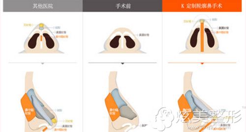 金在元院长做鼻部整形案例 金在元院长做鼻部整形案例