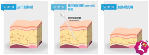 李康宇院长做吸脂手术原理 李康宇院长做吸脂手术原理