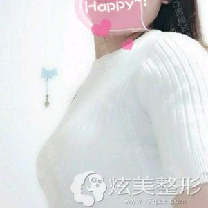 甘泉涌医生为我做娜绮丽假体隆胸术后胸部微肿 甘泉涌医生为我做娜绮丽假体隆胸术后胸部微肿