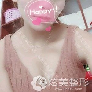 在合肥壹加壹做假体隆胸术后3个月恢复自然 在合肥壹加壹做假体隆胸术后3个月恢复自然