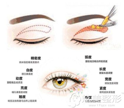 李春新医生做美杜莎TTL综合美眼术原理 李春新医生做美杜莎TTL综合美眼术原理