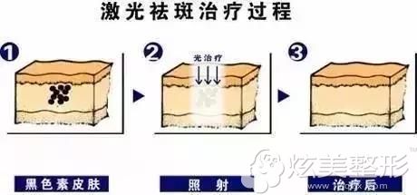 恩施华美超光子嫩肤祛斑治疗简易图 恩施华美超光子嫩肤祛斑治疗简易图