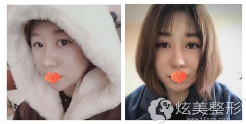 在烟台鹏爱做隆鼻失败修复术后半个月鼻子消肿很多 在烟台鹏爱做隆鼻失败修复术后半个月鼻子消肿很多