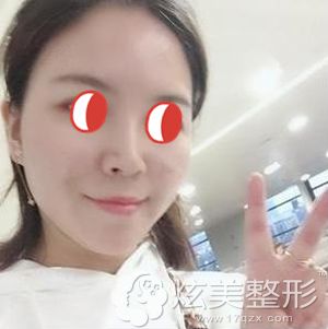 做埋线提升术后20天法令纹明显变浅肿胀消失 做埋线提升术后20天法令纹明显变浅肿胀消失