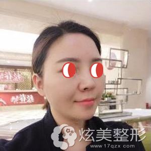 李花停主任帮我做埋线提升术后即刻肿胀轻微针眼很小 李花停主任帮我做埋线提升术后即刻肿胀轻微针眼很小
