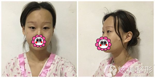 面诊卢开锐院长术前的妞妞单眼皮 面诊卢开锐院长术前的妞妞单眼皮
