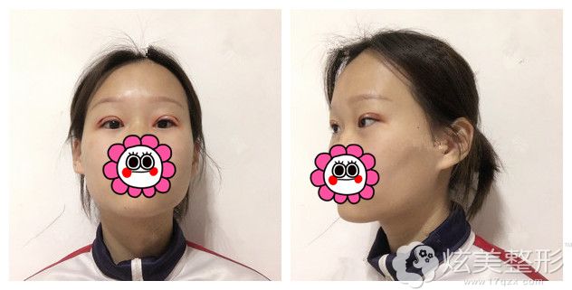 做双眼皮术后四天消肿恢复中 做双眼皮术后四天消肿恢复中