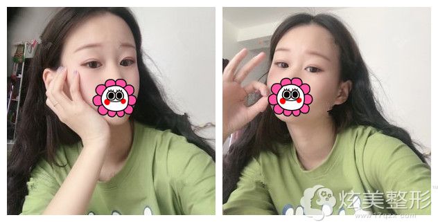 到常德伊丽莎白做双眼皮术后效果 到常德伊丽莎白做双眼皮术后效果