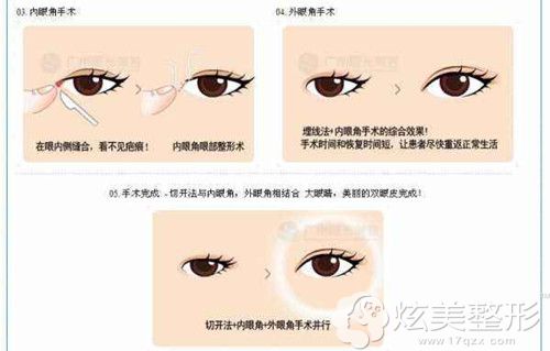 金圣训做眼综合整形手术案例 金圣训做眼综合整形手术案例