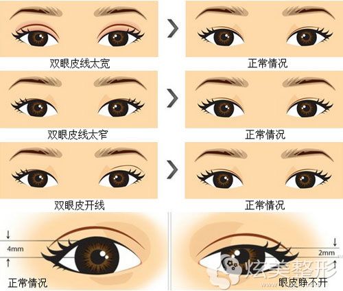 双眼皮失败的多种不同情况 双眼皮失败的多种不同情况