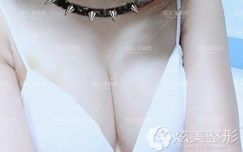 做自体脂肪丰胸术后30天肿胀消除淤青消退 做自体脂肪丰胸术后30天肿胀消除淤青消退