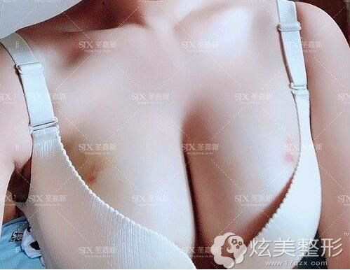 李院长做自体脂肪丰胸术后3天饱满效果 李院长做自体脂肪丰胸术后3天饱满效果
