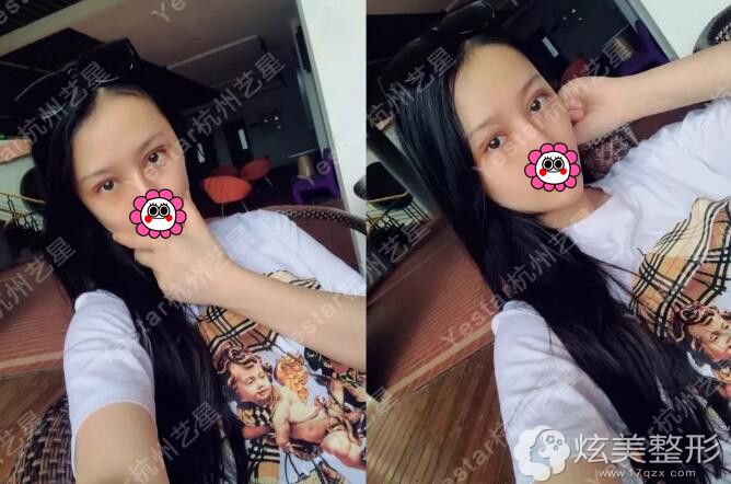 �ں���������˫��Ƥʧ���޸���������Ч��