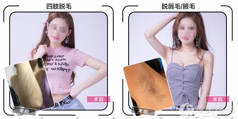 到运城华美脱毛案例 到运城华美脱毛案例