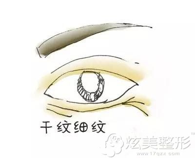 眼周出现干纹细纹的表现 眼周出现干纹细纹的表现