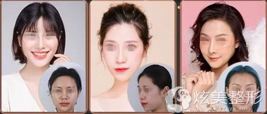 察鹏飞博士做隆鼻失败修复案例 察鹏飞博士做隆鼻失败修复案例