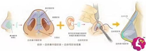 福州名韩察鹏飞博士做隆鼻失败修复过程 福州名韩察鹏飞博士做隆鼻失败修复过程