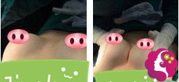 姚远医生刚为我做完假体隆胸术后胸部高挺 姚远医生刚为我做完假体隆胸术后胸部高挺