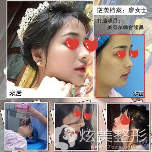 黄院长做肋软骨隆鼻术前术后对比效果 黄院长做肋软骨隆鼻术前术后对比效果