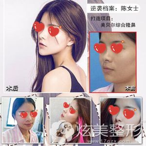 黄院长做肋软骨综合隆鼻改善猪鼻子 黄院长做肋软骨综合隆鼻改善猪鼻子