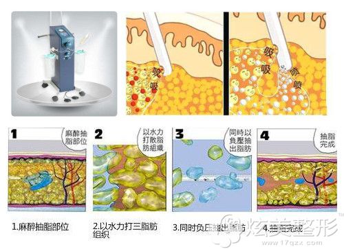 刘申松医生讲解水动力吸脂手术瘦身过程 刘申松医生讲解水动力吸脂手术瘦身过程
