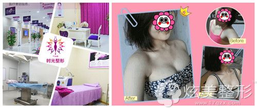 桂林时光整形美容门诊部丰胸案例 桂林时光整形美容门诊部丰胸案例
