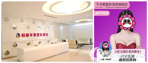 桂林华美做自体脂肪丰胸案例 桂林华美做自体脂肪丰胸案例