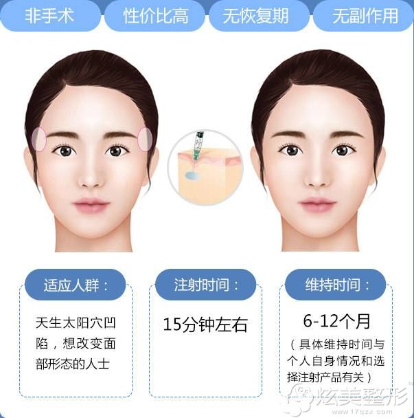玻尿酸丰太阳穴原理 玻尿酸丰太阳穴原理