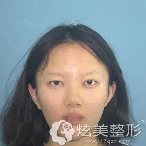 在绍兴上虞艺美整形做眼综合术前是单眼皮小眼睛 在绍兴上虞艺美整形做眼综合术前是单眼皮小眼睛