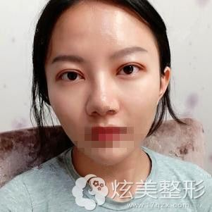 卢帅华医生为我做眼综合术后10天眼睛微肿 卢帅华医生为我做眼综合术后10天眼睛微肿