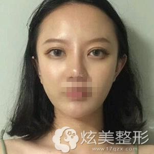 在绍兴上虞艺美整形做眼综合18天完全消肿 在绍兴上虞艺美整形做眼综合18天完全消肿