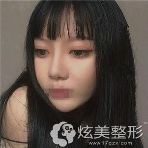 卢帅华医生为我做眼综合术后2个月恢复自然和谐 卢帅华医生为我做眼综合术后2个月恢复自然和谐
