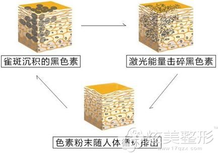 激光祛雀斑的原理分享 激光祛雀斑的原理分享