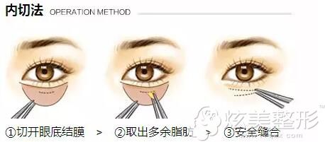 内切法去眼袋手术原理 内切法去眼袋手术原理