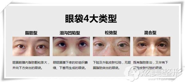 四种不同情况的眼袋问题 四种不同情况的眼袋问题