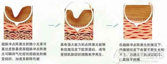 脉冲光点阵激光治疗凹陷性疤痕 脉冲光点阵激光治疗凹陷性疤痕