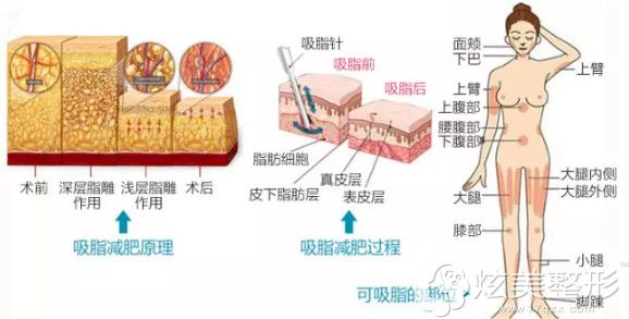 黄中志医生做水动力吸脂手术过程 黄中志医生做水动力吸脂手术过程