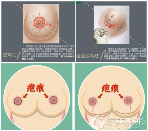 传统的乳房提升分为双环法和垂直双蒂法,整体来讲留疤明显 传统的乳房提升分为双环法和垂直双蒂法,整体来讲留疤明显