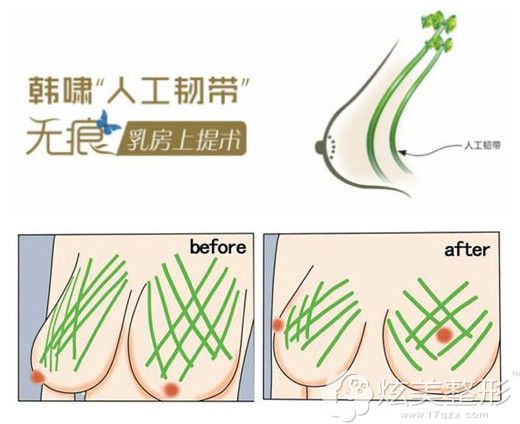 韩啸院长院长推出人工韧带乳房提升术 韩啸院长院长推出人工韧带乳房提升术
