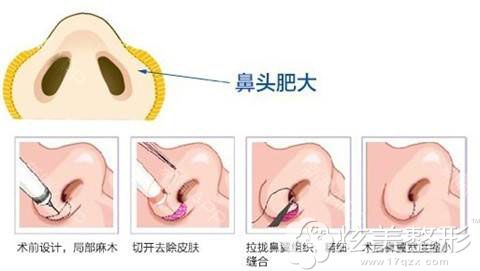 鼻头缩小手术过程 鼻头缩小手术过程
