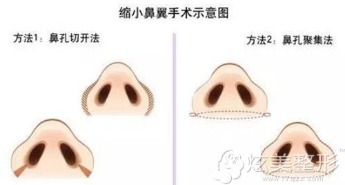 手术缩小鼻翼的方法 手术缩小鼻翼的方法