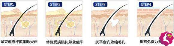 光动力,治疗中重度炎症痘痘 光动力,治疗中重度炎症痘痘