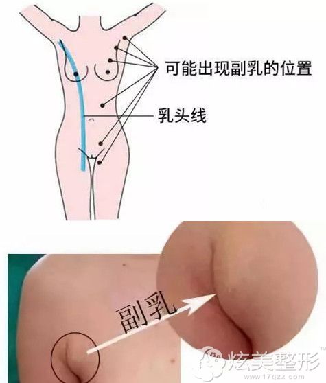 什么是副乳以及副乳可能出现的位置 什么是副乳以及副乳可能出现的位置