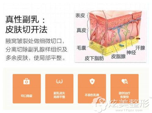 副乳切除手术原理 副乳切除手术原理