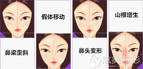 鼻部整形失败常见的几种类型 鼻部整形失败常见的几种类型