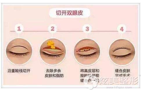 全切双眼皮的手术原理 全切双眼皮的手术原理