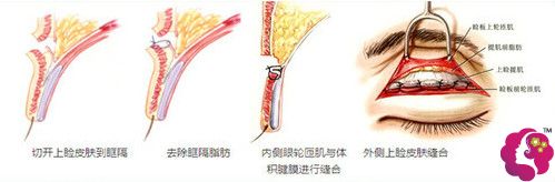 华美医疗美容门诊部做双眼皮手术过程 华美医疗美容门诊部做双眼皮手术过程