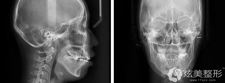 ��ǰ��x-ray�����沿��������ͻ���ȧ��