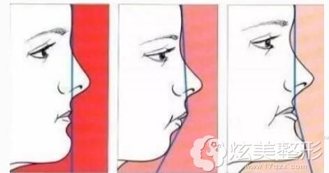 如何判断自己是否是鼻基底凹陷 如何判断自己是否是鼻基底凹陷